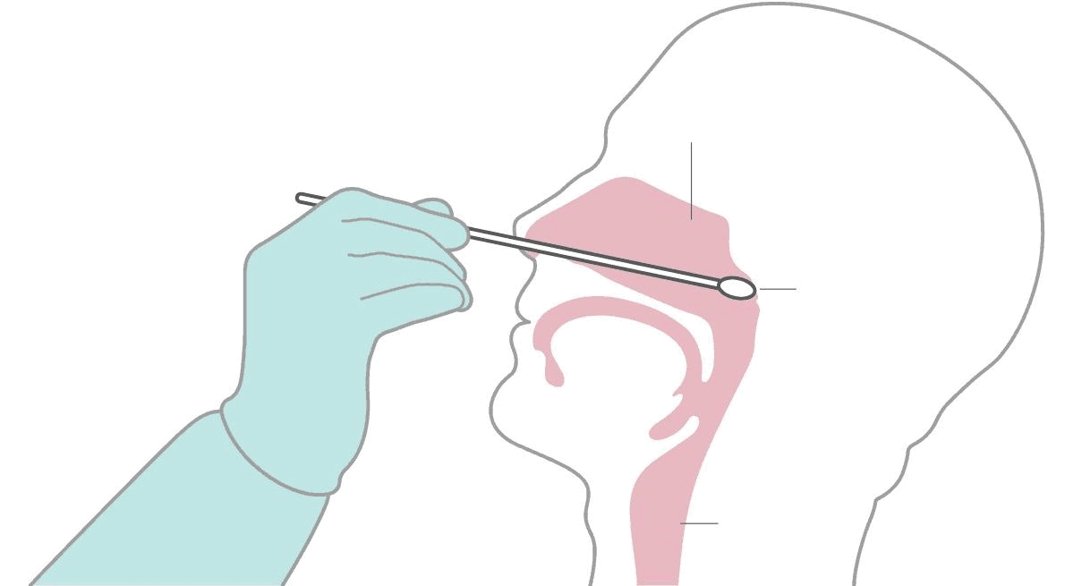 咽拭子如何提取病毒